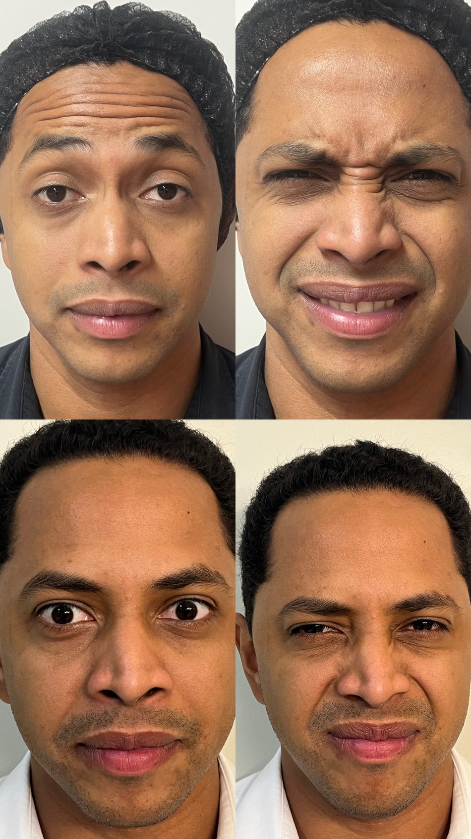 Botox em Goiânia — Dra. Auane Prudêncio
