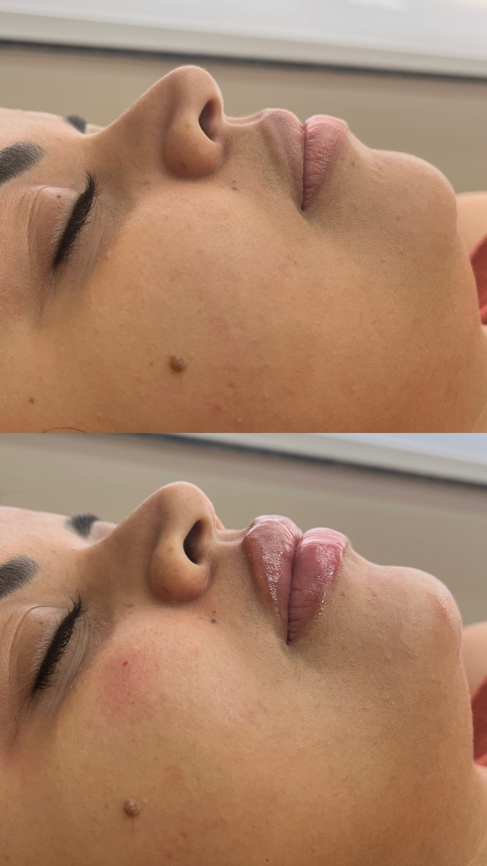 Harmonização Facial em Goiânia — Dra. Auane Prudêncio