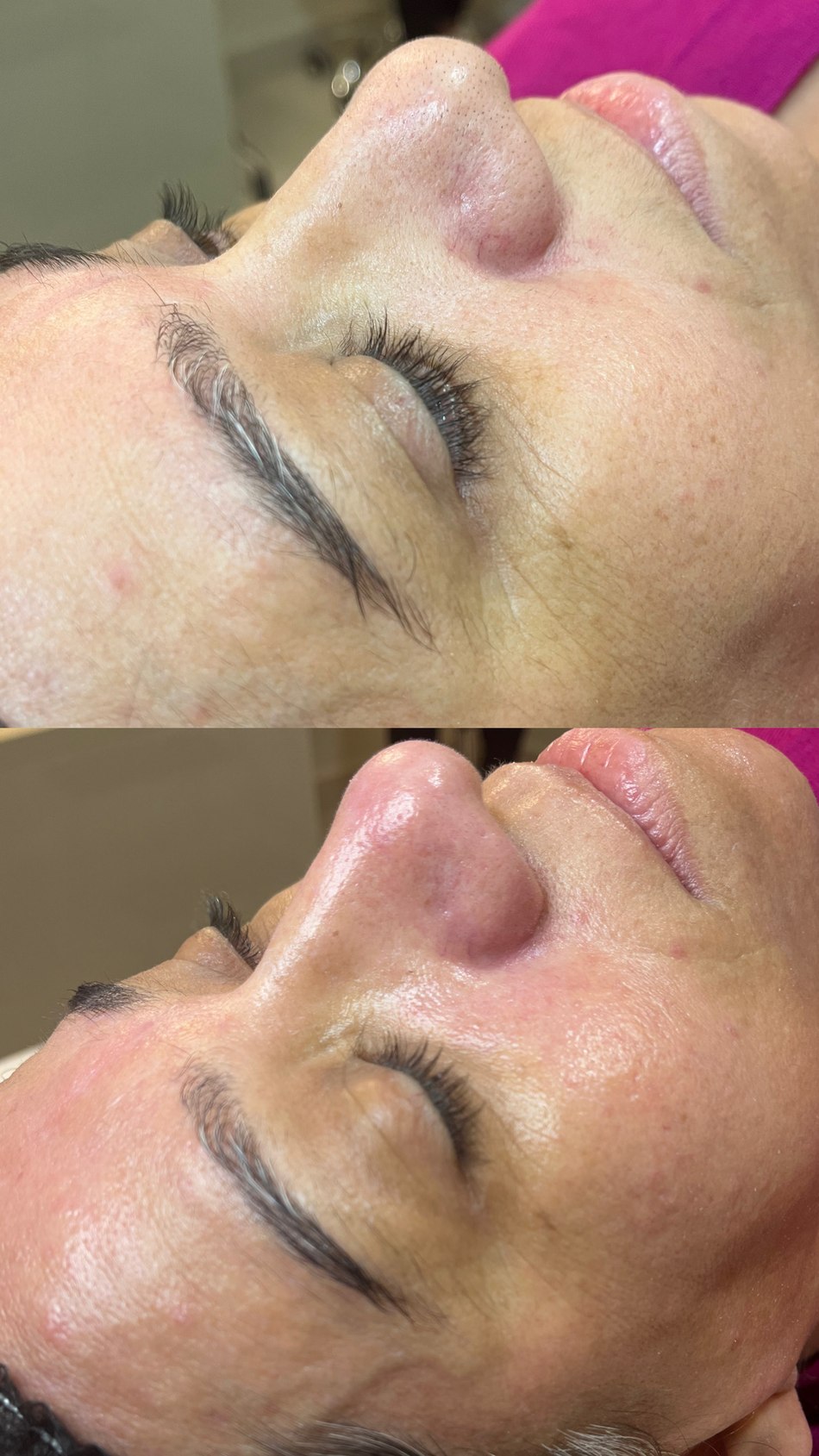 Antes e depois de limpeza de pele pela Dra. Auane Prudêncio