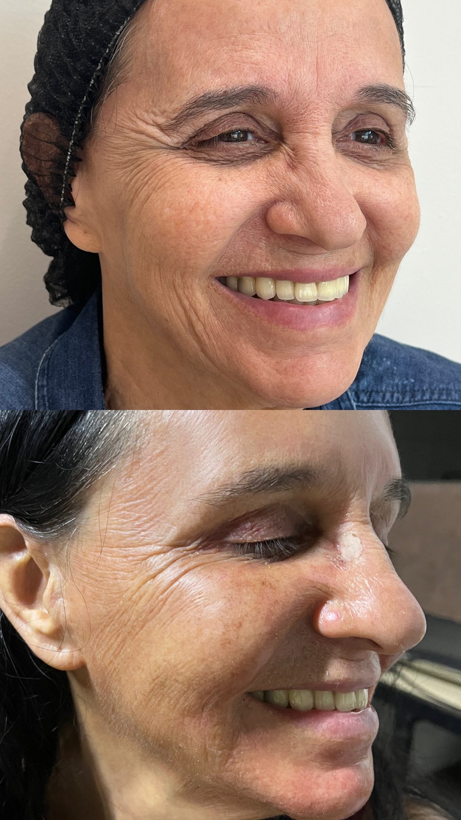 Peeling Químico em Goiânia — Dra. Auane Prudêncio