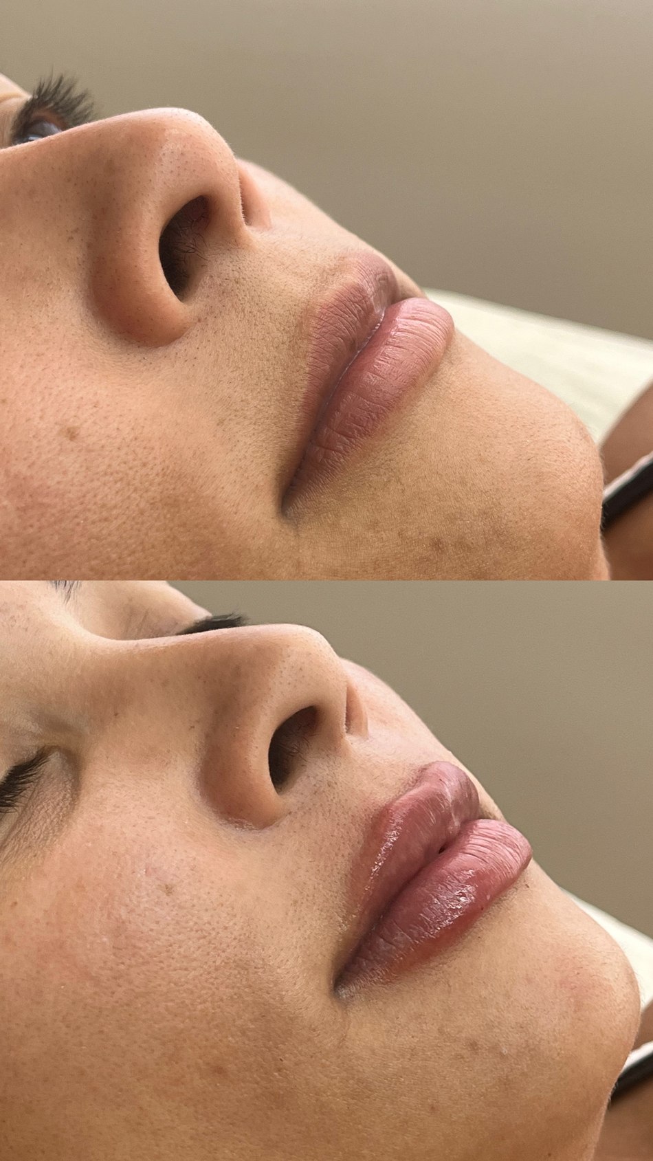 Preenchimento Labial em Goiânia — Dra. Auane Prudêncio
